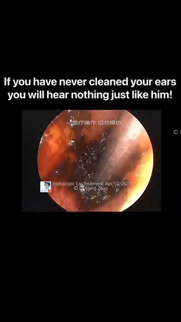 Best Ear Wax Removal & Extraction with Vacuum Remover 真空リムーバーによるにきびの除去と抽出 55 смотреть онлайн