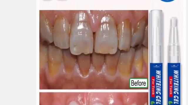 1 шт , ручка для отбеливания зубов и гигиены полости рта смотреть онлайн