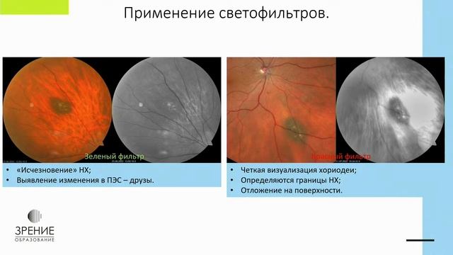 Мультимодальная диагностика невусов хориоидеи