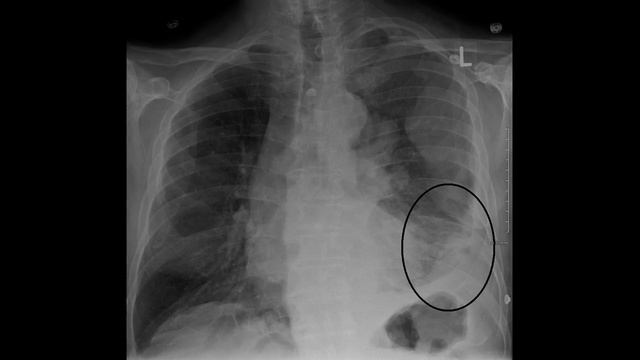 Как лечить и Лечение мезотелиомы смотреть онлайн
