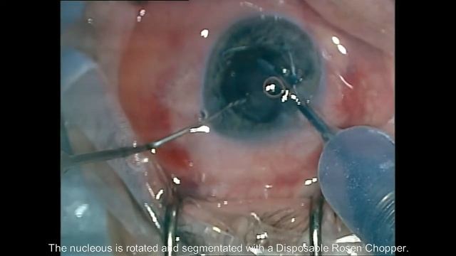 RUMEX | Femto Cataract performed with a set of Disposable Instruments смотреть онлайн