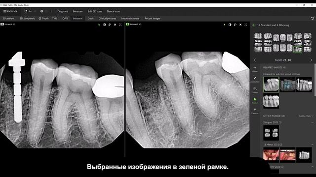 Диагностика полного снимка ротовой полости | DTX Studio Clinic смотреть онлайн