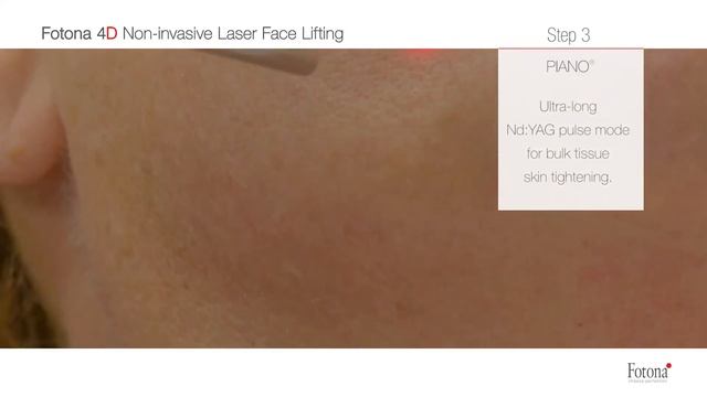 Fotona4D® combines Smooth, Frac3, Piano, and SupERficial modes смотреть онлайн