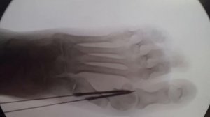 Dr SALMERON - Hallux Valgus