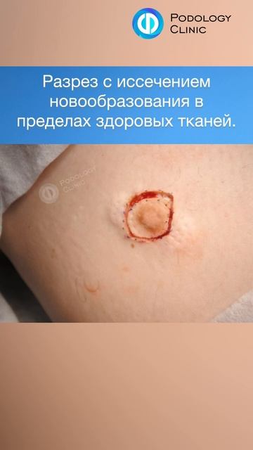 Удаление дерматофибромы #shorts  #хирургмосква #хирург #дерматофиброма #хирургия