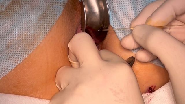 Laser Hemorrhoidectomy for External Hemorrhoids/ Лазерная геморроидэктомия