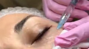 Мезотерапия вокруг глаз