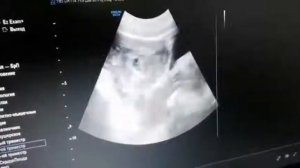 Замершая или прогрессирующая беременность