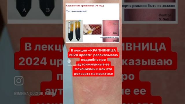 КРАПИВНИЦА 2024: что известно на сегодня - как обследовать и лечить смотреть онлайн