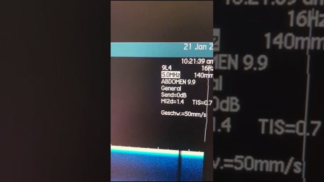 Siemens/Acuson Sequoia 512 смотреть онлайн