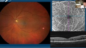 Клинический случай "Диабетическая ретинопатия"