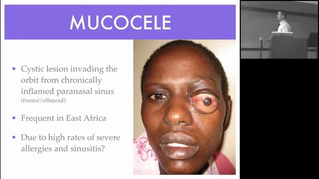 Tumors in the Tropics:  Diagnosis and Management