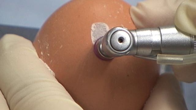 Набор LAS KIT. Практика с куриным яйцом. Часть 2