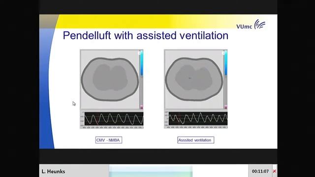 Why should we let our patients breathe even in ECMO Leo Heunks 2017