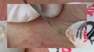 очищаем лицо от чёрных точек