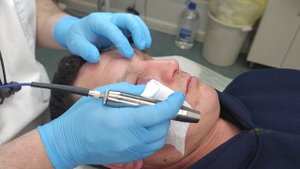 Безопасное удаление винного пятна под глазом с помощью жёлтого лазера