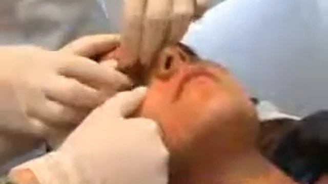 Q Switch Laser смотреть онлайн