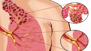 Болезни органов дыхательной системы. Причины возникновения