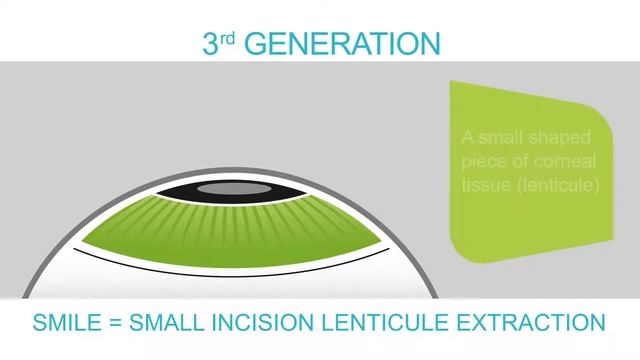 PRK - Femto LASIK - Femto / Relex SMILE Dubai /Abu Dhabi / UAE تصحيح النظر الليزك / ليزر في دبي смотреть онлайн