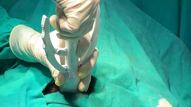 Zsr Circumcision For Phimosis | Live surgery and other details смотреть онлайн