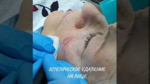 Удаление кератомы на лице. Радиоволновым методом (сургитроном).