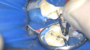 Пульпит нижнего моляра. Лечение корневых каналов