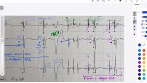 Непонятные комплексы на холтере пациента с ЭКС
