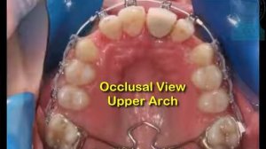 Ортодонтическое лечение (Брекет система) 2