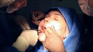 Удаление комков Биша