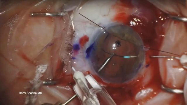 Dislocated PMMA Intraocular Lens 25 Years After Surgery- Scleral tunnel extraction and Yamane ISHF смотреть онлайн