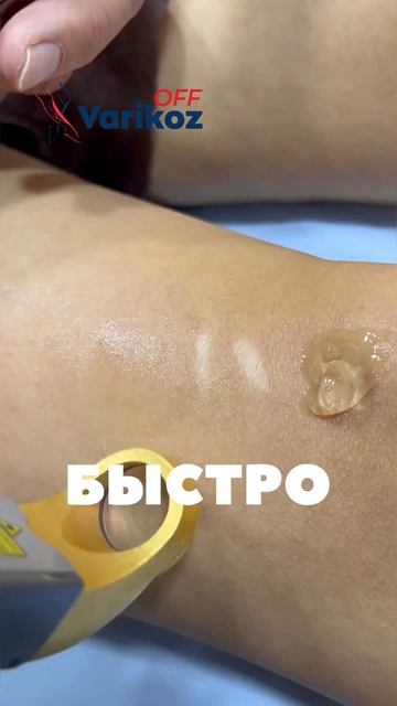 Трансдермальная лазерная коагуляция ТЕЛЕАНГИОЭКТАЗИИ.