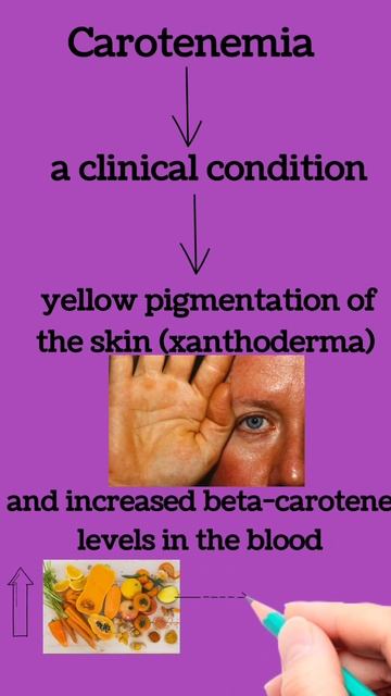 Carotenemia/#exitexam #gpatexam #mrbpharmacist #pathophysiology #pathology смотреть онлайн