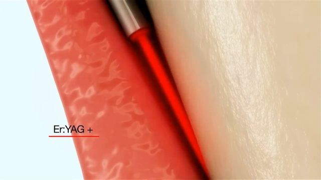 Lightwalker Laser - The Highest Technology Dental Laser System смотреть онлайн