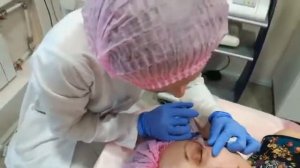 Биоревитализация зоны вокруг глаз