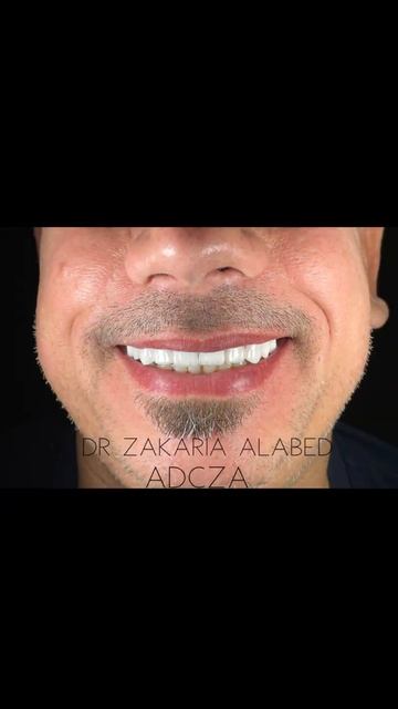 #Ceramic#E-max#Crown#Veneer Smile#Hollywoodsmile#dentist смотреть онлайн