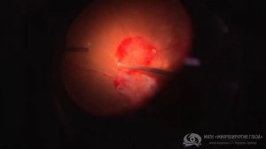 Хирургическое лечение гемофтальма и тракционной отслойки сетчатки на фоне сахарного диабета 1 типа