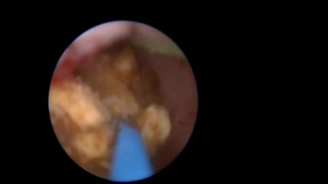 Трансуретральная уретеролитотрипсия. Новый режим UltraPulse в лазерах UROLASE