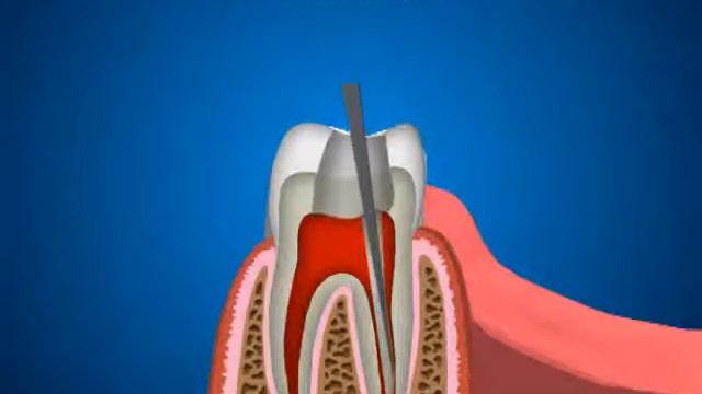 Терапевтическая стоматология Пульпит и пломбирование кк термогуттаперчей смотреть онлайн