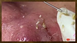 Relaxing with Top Skin #031 Blackhead Nose