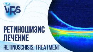 Ретиношизис. Лечение | Retinoschisis. Treatment