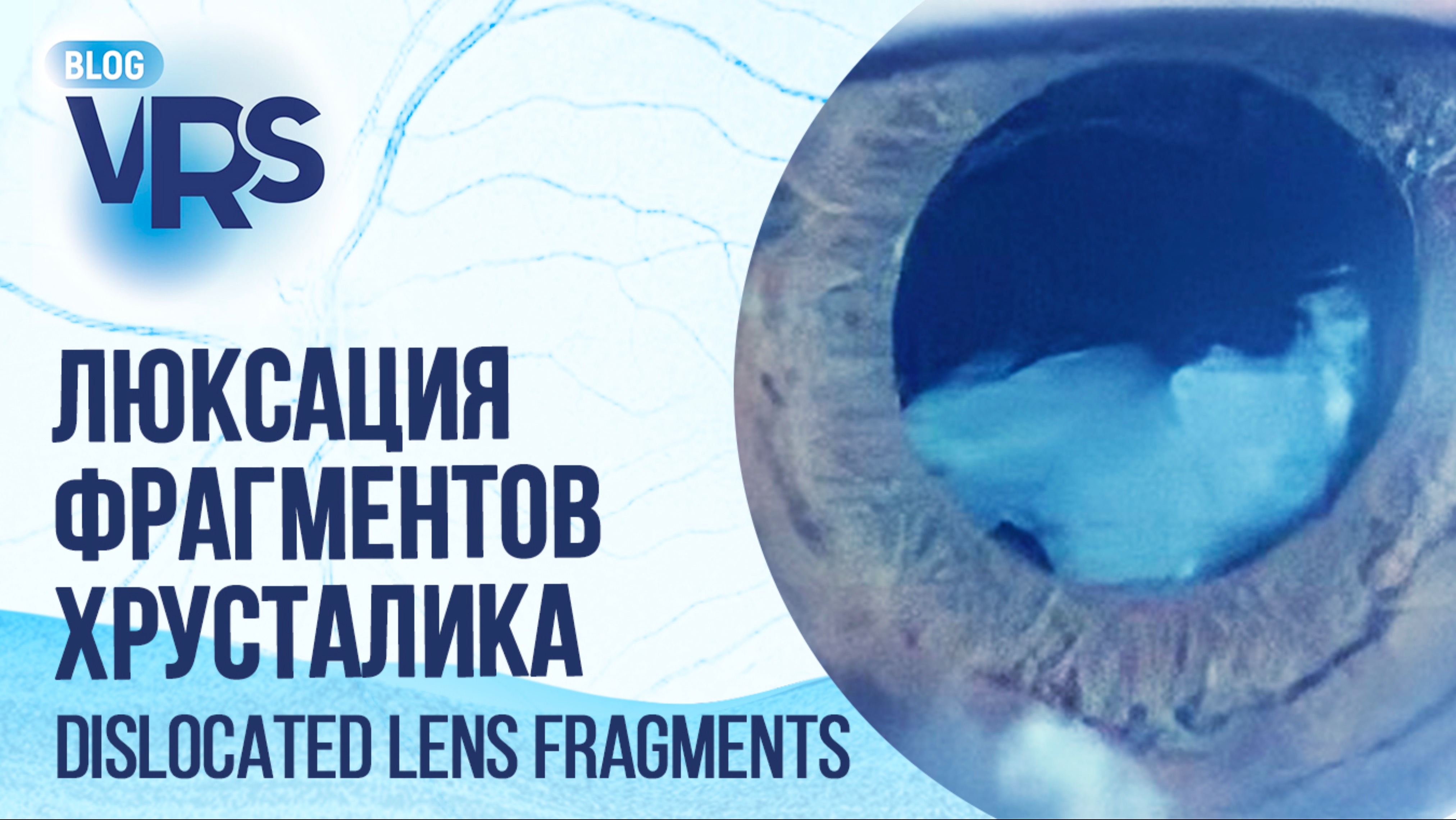 Люксация фрагметов хруслалика | Dislocated lens fragments