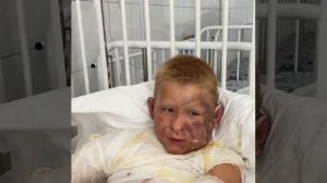 Мальчик с ожогами из Запорожской области нуждается в помощи