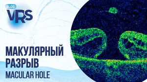 Макулярный разрыв. Хирургическое лечение | Macular hole. Treatment