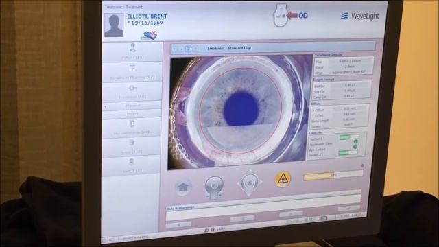 Topography-guided LASIK as a new option for treatment of myopia with or without astigmatism. смотреть онлайн