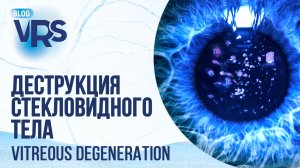 Деструкция стекловидного тела: нужно ли оперировать? | Vitreous degeneration: to operate or not?