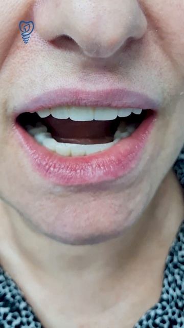 Временные проверочные зубы. С такими можно и на свадьбу. Имплантация зубов. смотреть онлайн