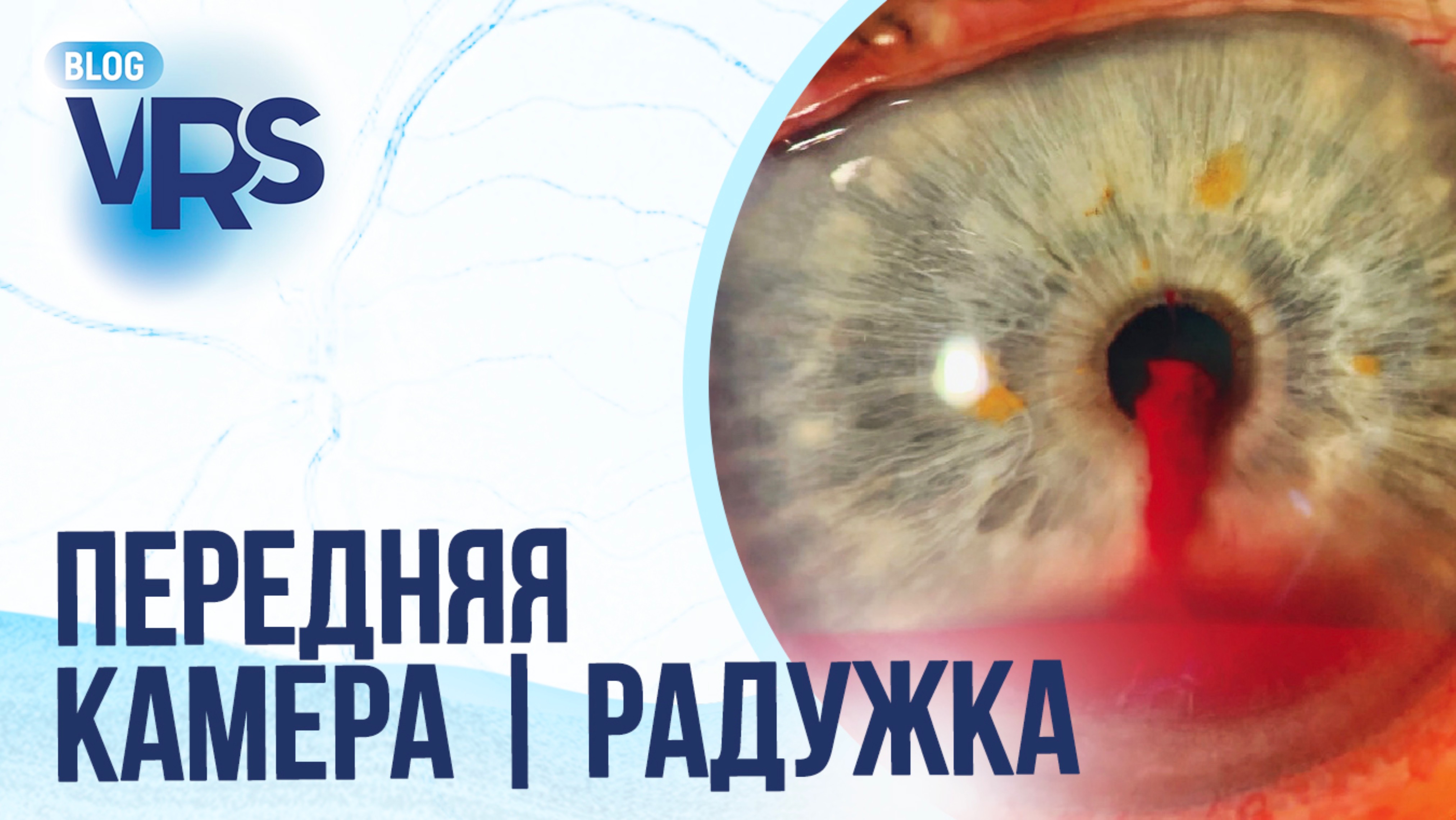 Травма глаза / Передняя камера и радужка