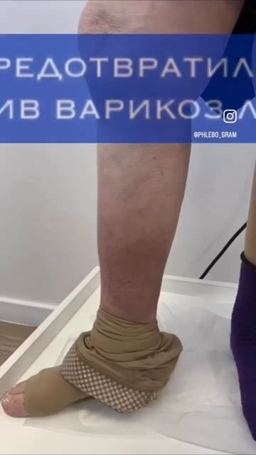 Стоп варикоз. Прогрессирование варикоза можно остановить. Флеболог Якушкин