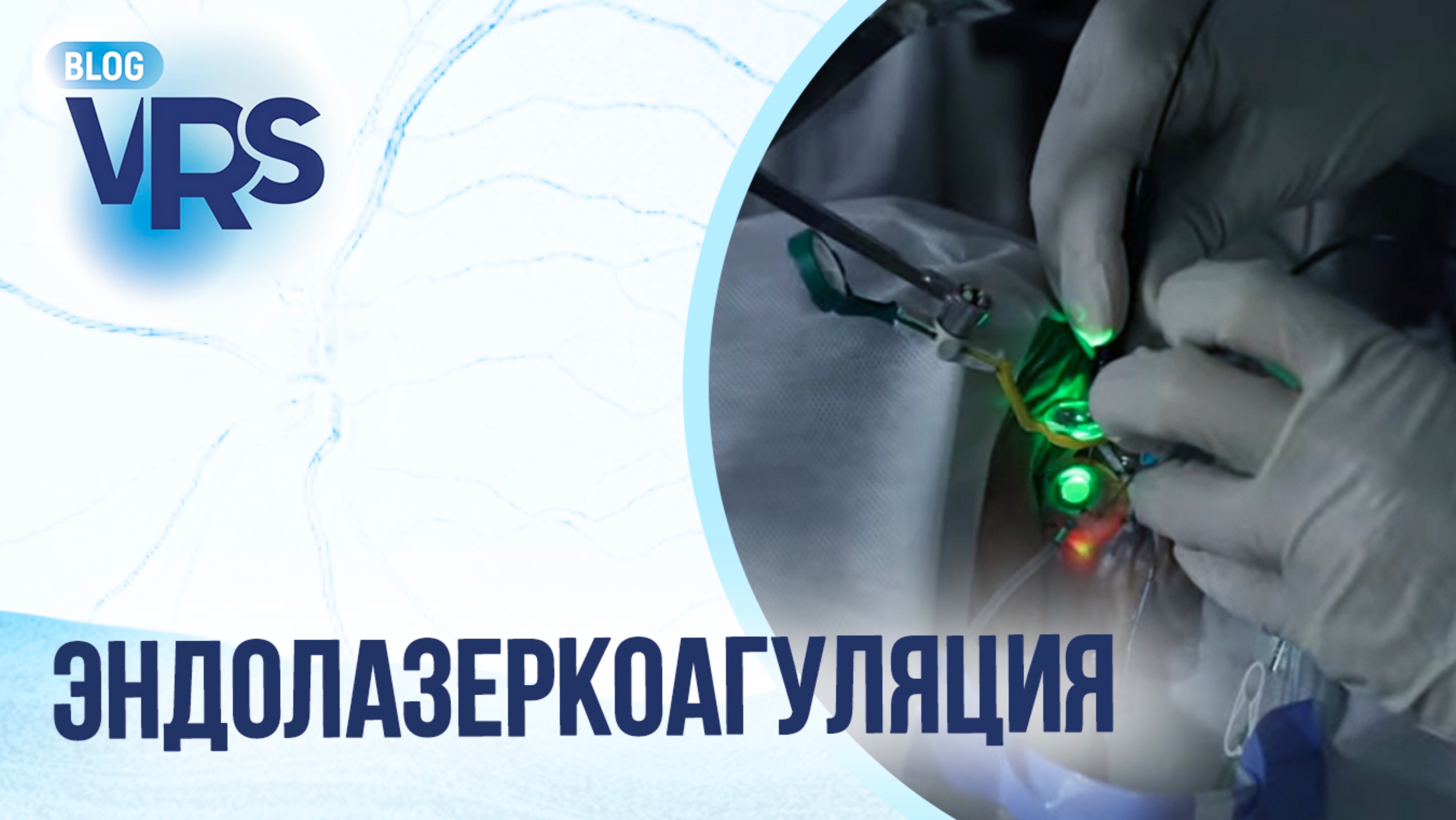 Сахарный диабет / Диабетическая ретинопатия / Эндолазеркоагуляция
