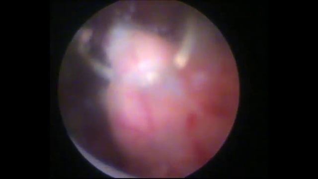 Трансуретральная резекция уретероцеле. смотреть онлайн